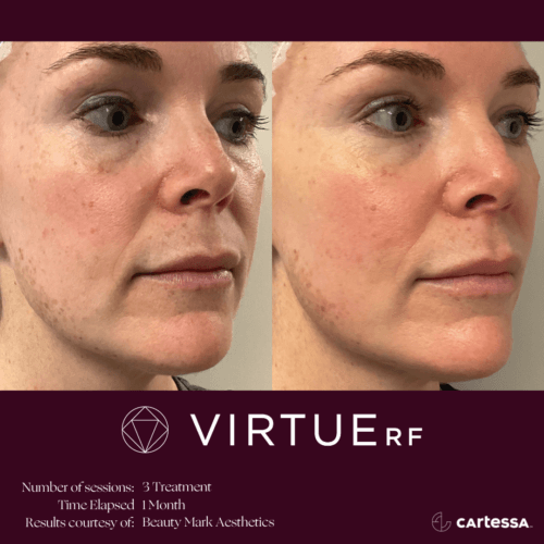 Virtue RF Microneedling Before and After By Enchanted Medical Aesthetics