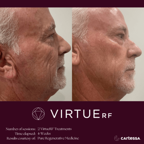 Virtue RF Microneedling Before and After By Enchanted Medical Aesthetics