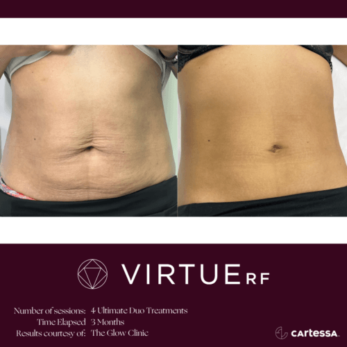 Stomach Virtue RF Microneedling Before and After By Enchanted Medical Aesthetics
