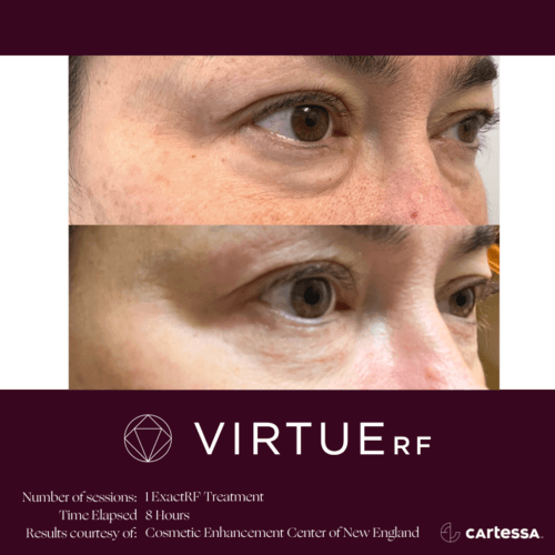 Virtue RF Microneedling Before and After By Enchanted Medical Aesthetics