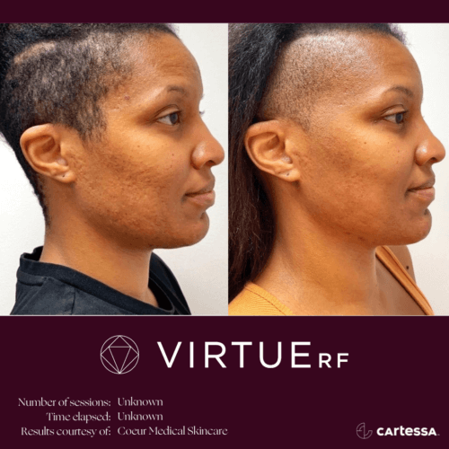 Virtue RF Microneedling Before and After By Enchanted Medical Aesthetics