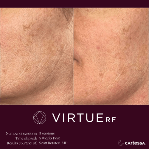 Virtue RF Microneedling Before and After By Enchanted Medical Aesthetics