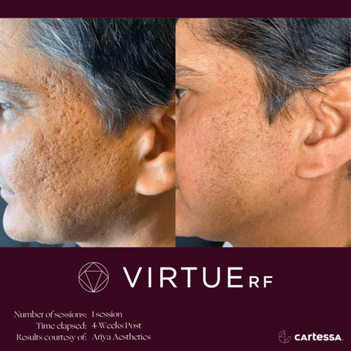 Virtue RF Microneedling Before and After By Enchanted Medical Aesthetics