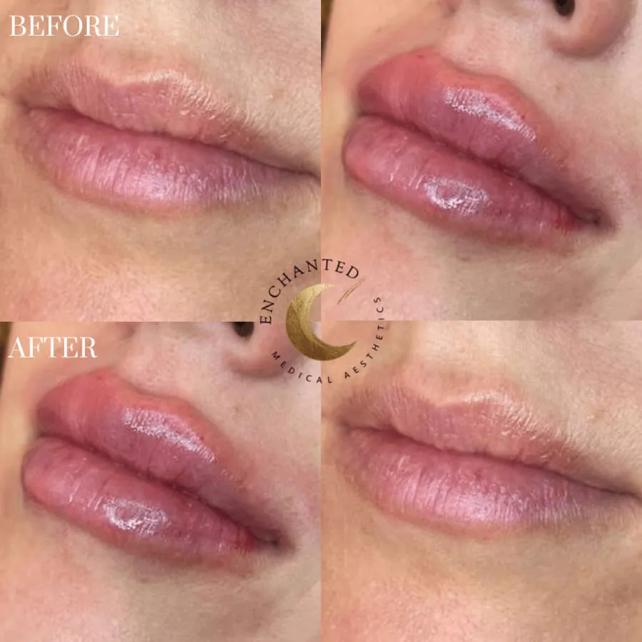 Lip Filler Before and After Photos By Enchanted Medical Aesthetics