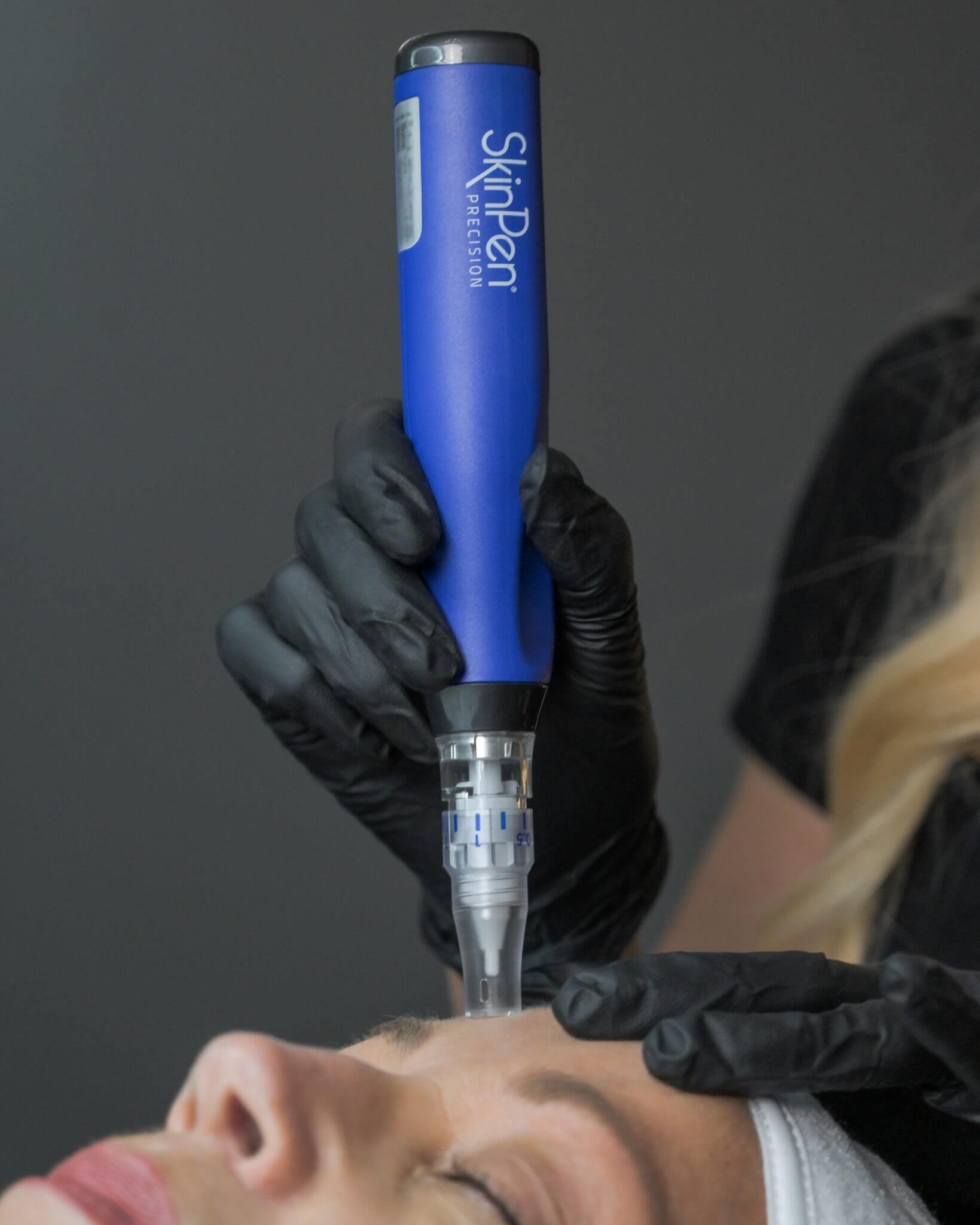 Microneedling with PRP in Ormond Beach, FL