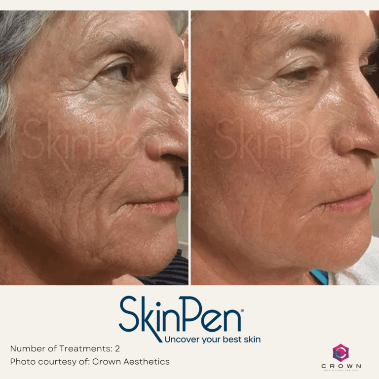 Microneedling with PRP Before and After By Enchanted Medical Aesthetics