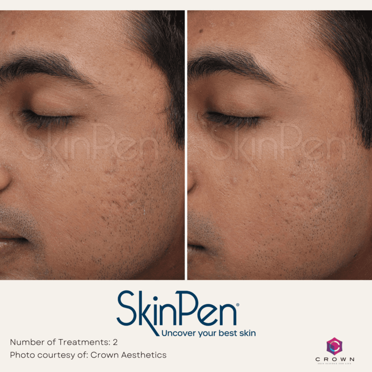 Microneedling with PRP Before and After By Enchanted Medical Aesthetics