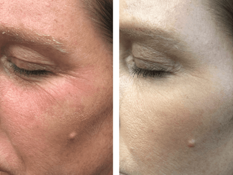 Subnovii Plasma Pen Treatment Before and After By Enchanted Medical Aesthetics