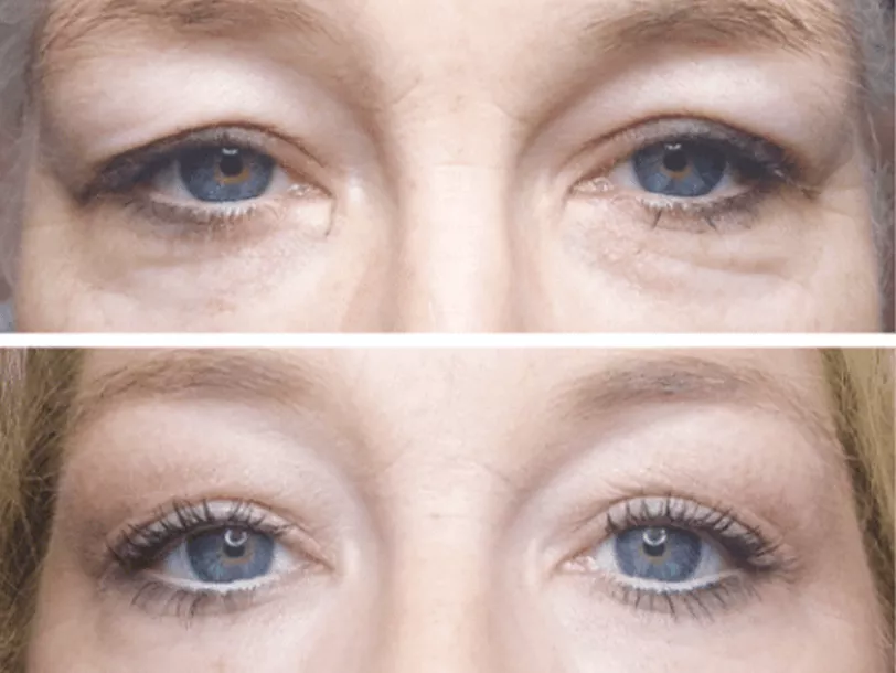 Subnovii Plasma Pen Treatment Before and After By Enchanted Medical Aesthetics