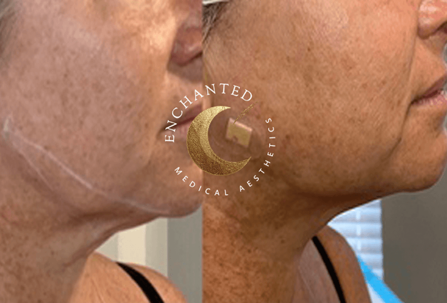 Thread lift Treatment Before and After By Enchanted Medical Aesthetics