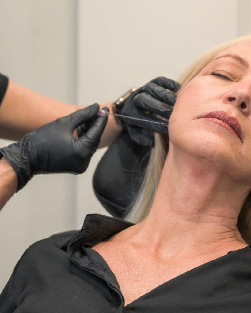 PDO Thread lifts treatment for facial rejuvenation Ormond Beach, FL