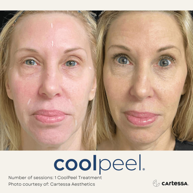 Coolpeel Treatment Before and After By Enchanted Medical Aesthetics