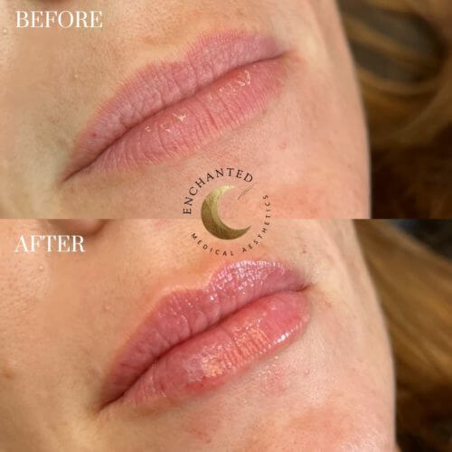 Lip Filler Before and After By Enchanted Medical Aesthetics