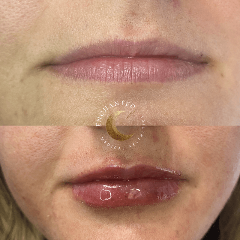 Enhance Your Smile! Stunning Lip Filler Before & After Transformations