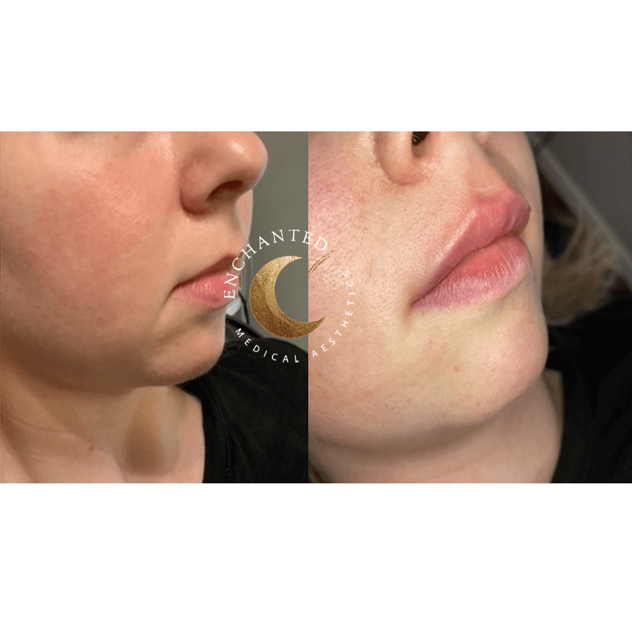 See the Difference! Lip Filler Before & After by Enchanted Aesthetics