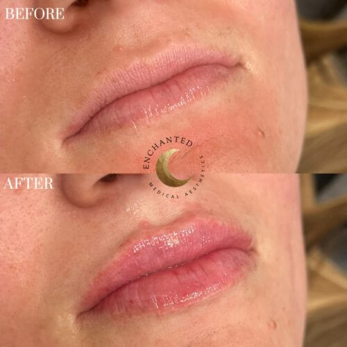 Lip Filler Before and After By Enchanted Medical Aesthetics