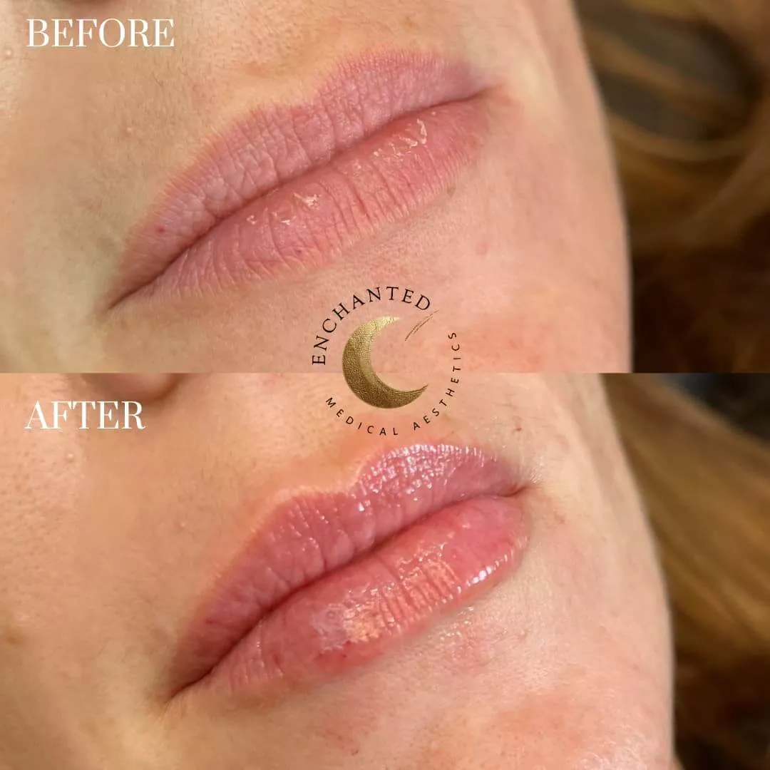 Lip Filler Before and After By Enchanted Medical Aesthetics