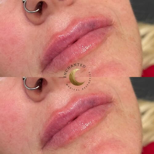 Lip Filler Before and After By Enchanted Medical Aesthetics