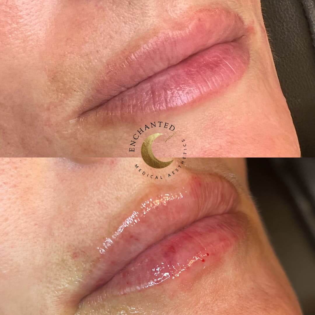 Lip Filler Before and After By Enchanted Medical Aesthetics