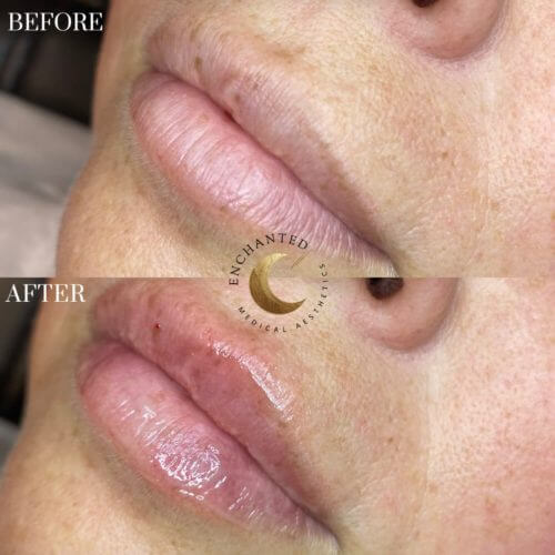 Lip Filler Before and After By Enchanted Medical Aesthetics