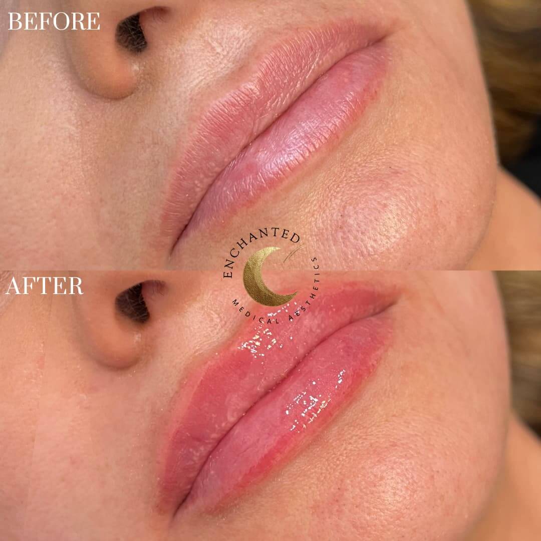 Lip Filler Before and After By Enchanted Medical Aesthetics