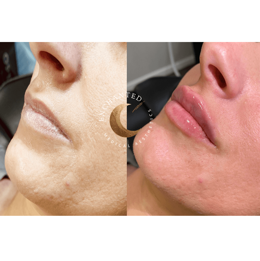 See Stunning Lip Filler Before & After