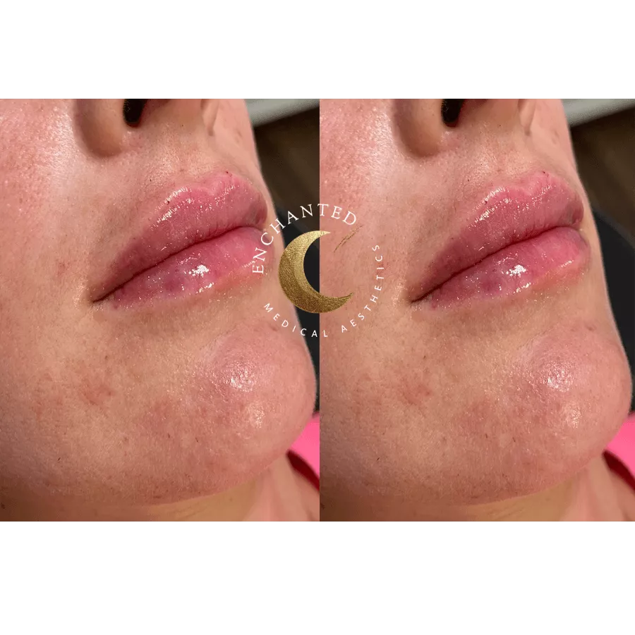 Lip Filler Before and After By Enchanted Medical Aesthetics