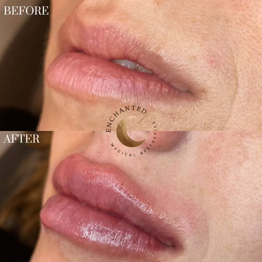 Lip Filler Before and After By Enchanted Medical Aesthetics