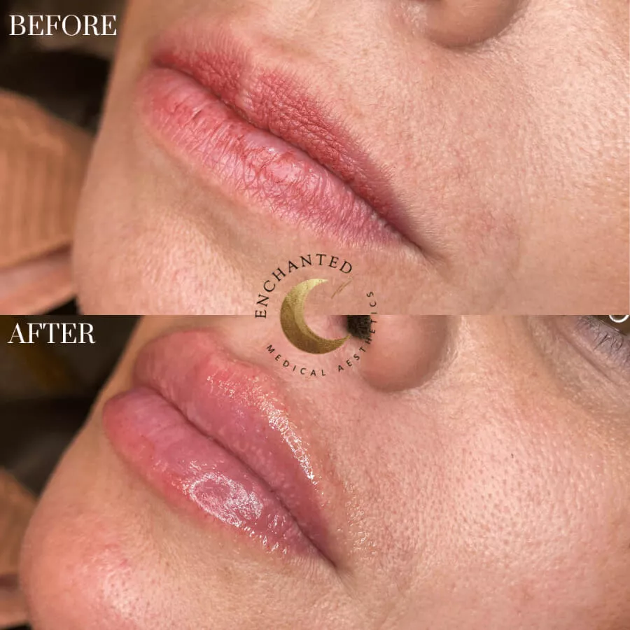 Lip Filler Before and After By Enchanted Medical Aesthetics