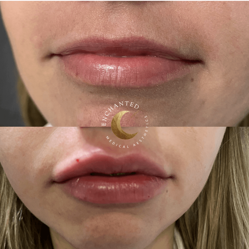 Transform Your Lips – View Lip Filler Before & After & Book Today!