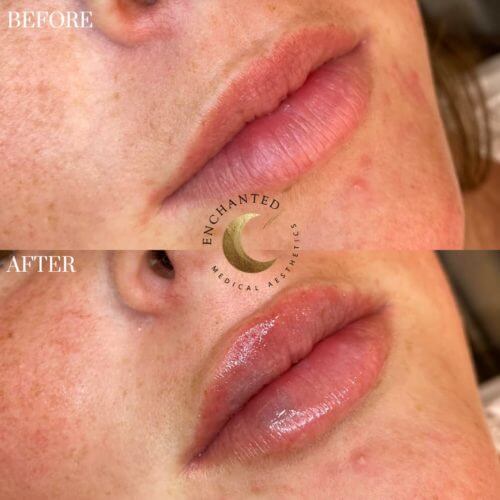 Lip Filler Service Before and After By Enchanted Medical Aesthetics