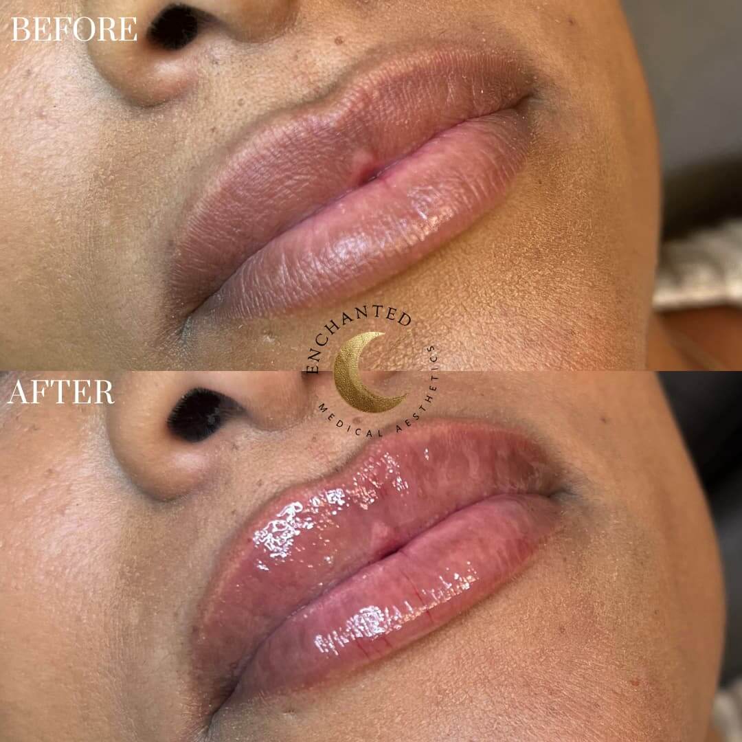 lip filler treatment before after in ormond beach fl