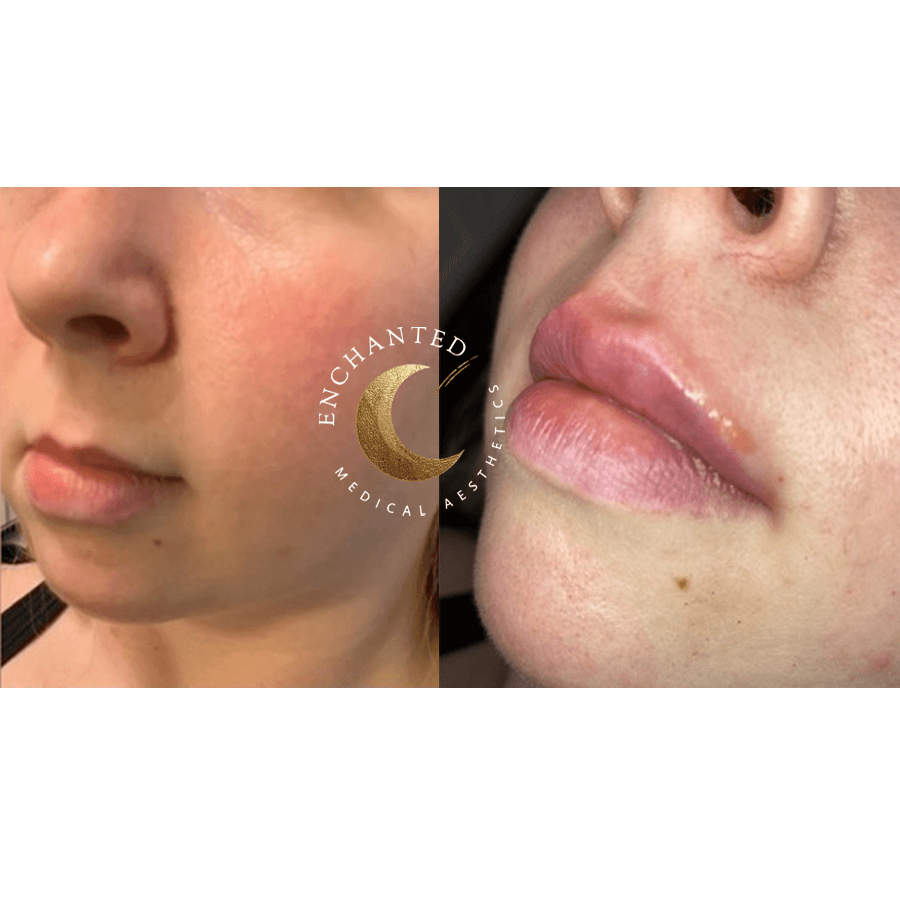Love Your Lips! Check Out Our Filler Before & After Transformations