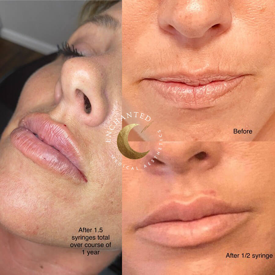Plump, Defined, Beautiful! Lip Filler Before & Afters You Must See