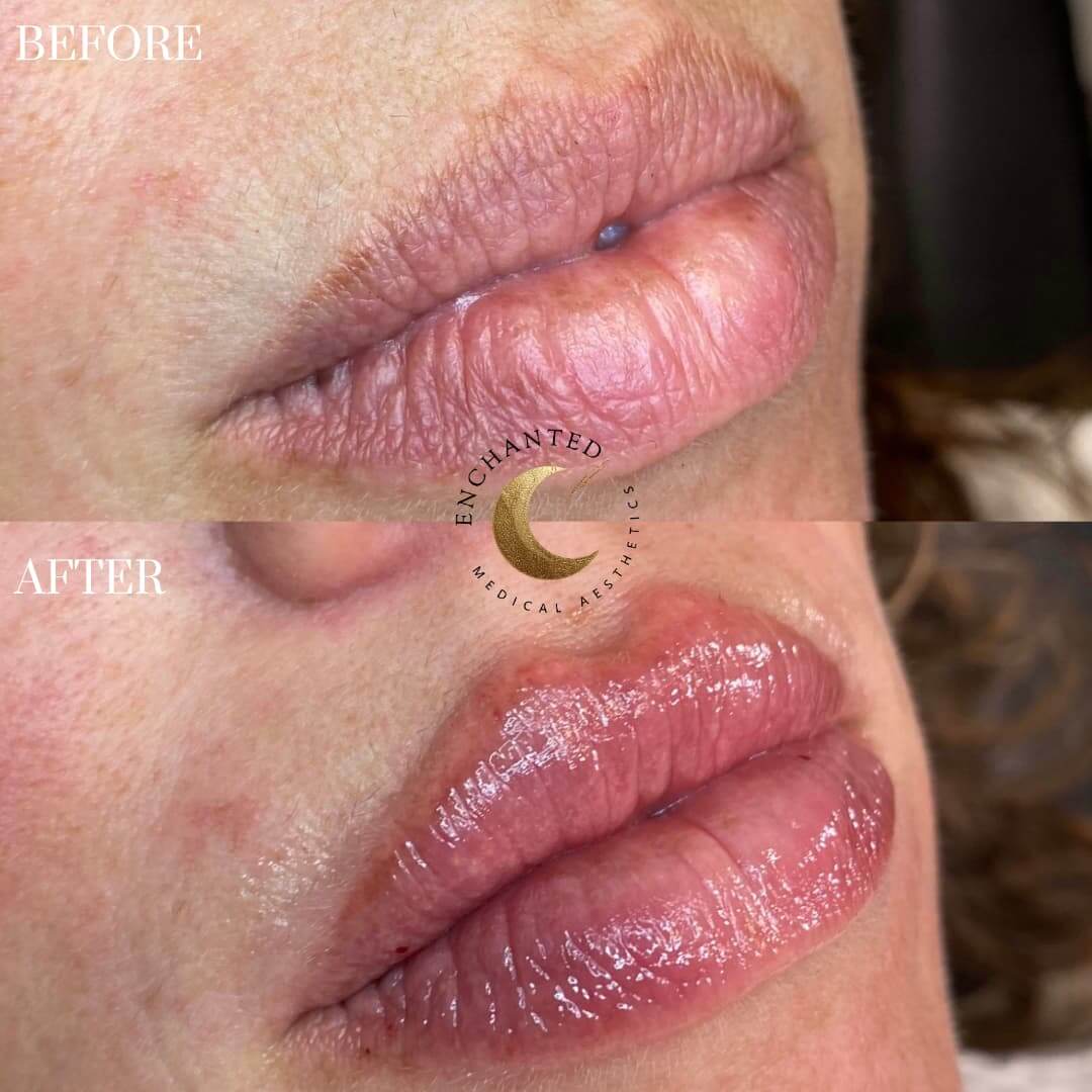 Get the Perfect Pout! Lip Filler Before & After Results You’ll Love