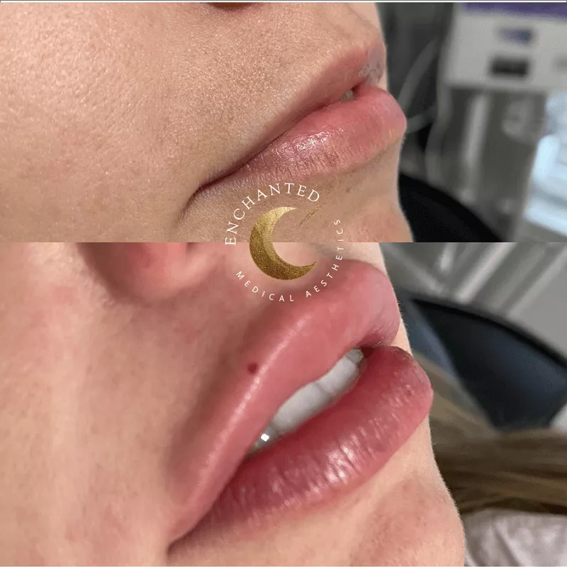 Lip Filler Treatment Before and After By Enchanted Medical Aesthetics