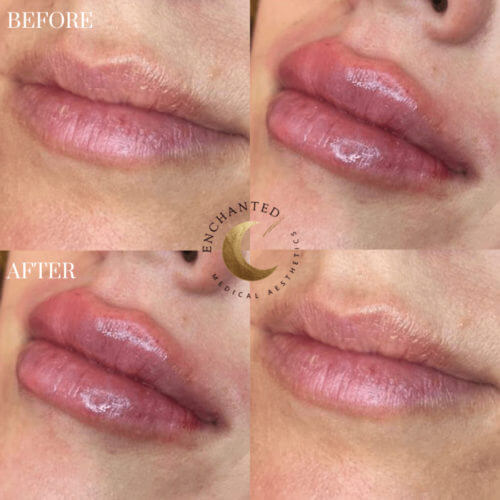 Lip Filler Before and After By Enchanted Medical Aesthetics