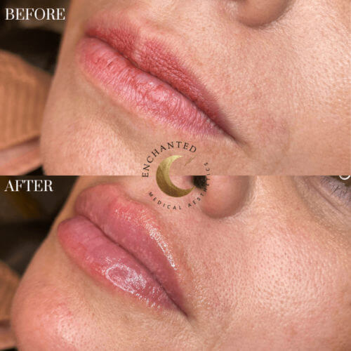 Lip Filler Before and After By Enchanted Medical Aesthetics