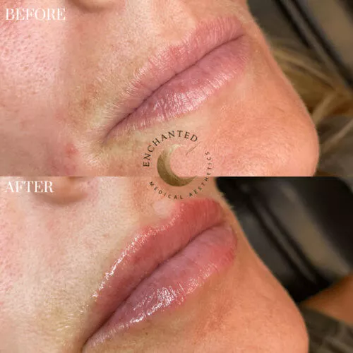 Lip Filler Before and After By Enchanted Medical Aesthetics