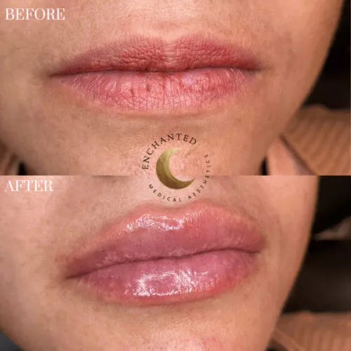 Lip Filler Before and After By Enchanted Medical Aesthetics