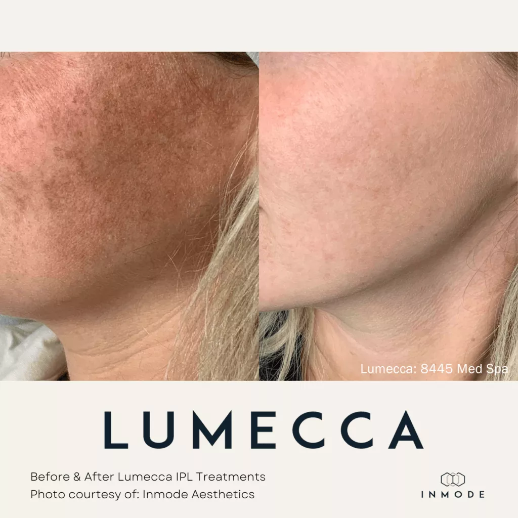 Lumecca IPL Treatment Before and After By Enchanted Medical Aesthetics