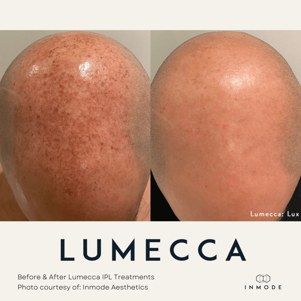Lumecca IPL Treatment Before and After By Enchanted Medical Aesthetics