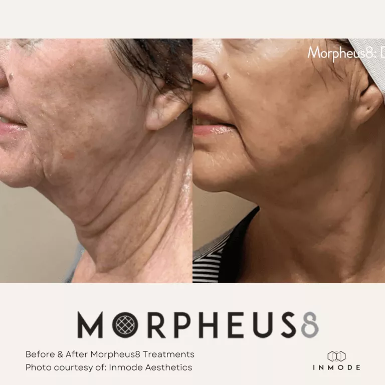 Morpheus8 Treatments Before and After By Enchanted Medical Aesthetics