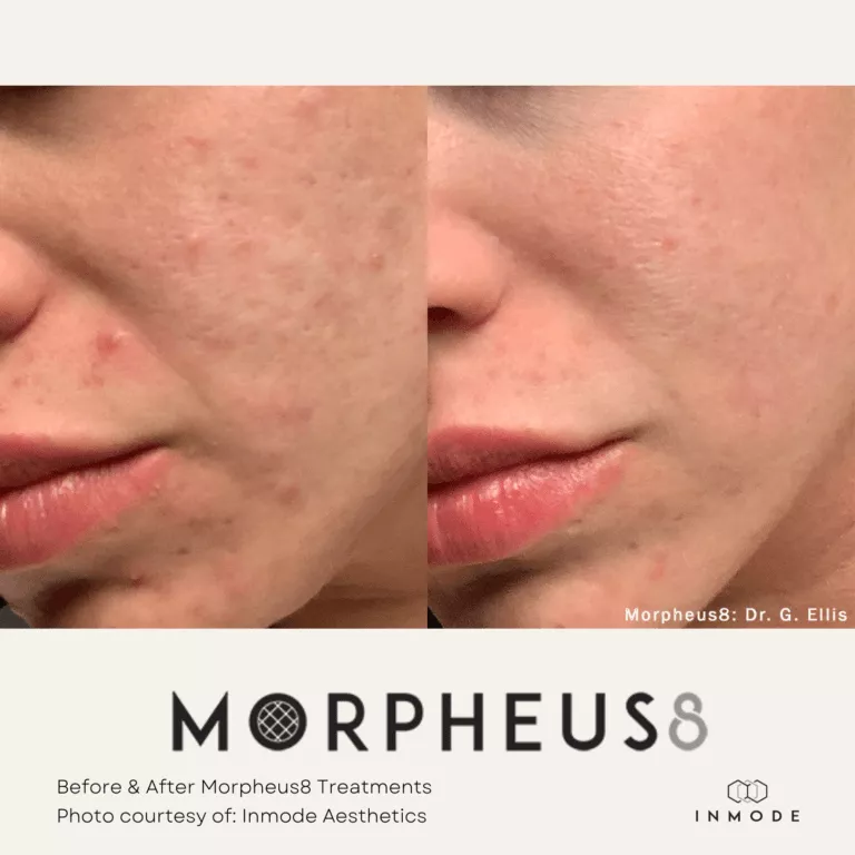 Morpheus8 Treatment Before and After By Enchanted Medical Aesthetics