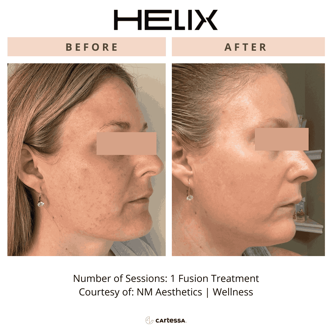 Before after image of pdo lifting threads | Enchanted Medical Aesthetics | Ormond Beach, FL