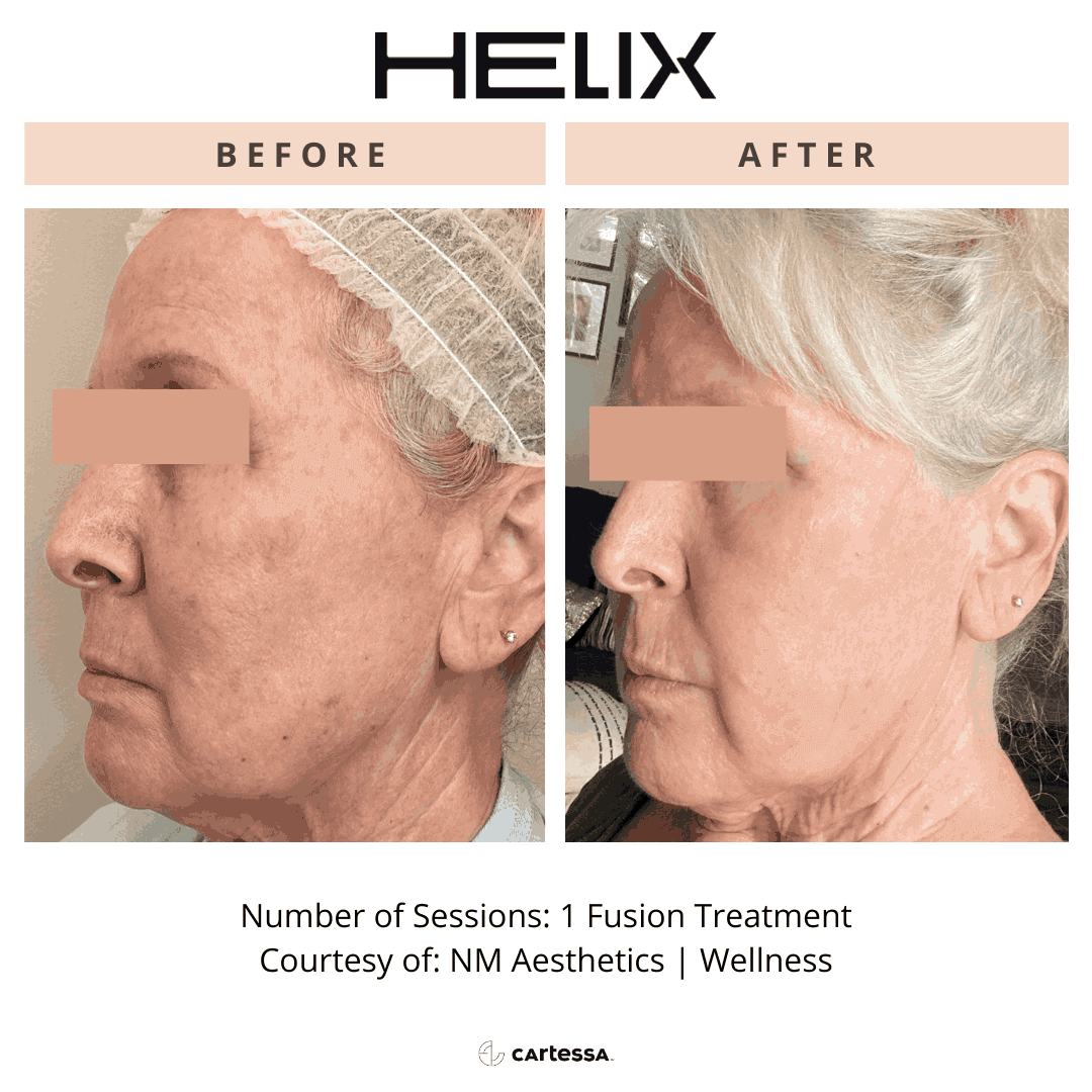 Helix Before and After By Enchanted Medical Aesthetics