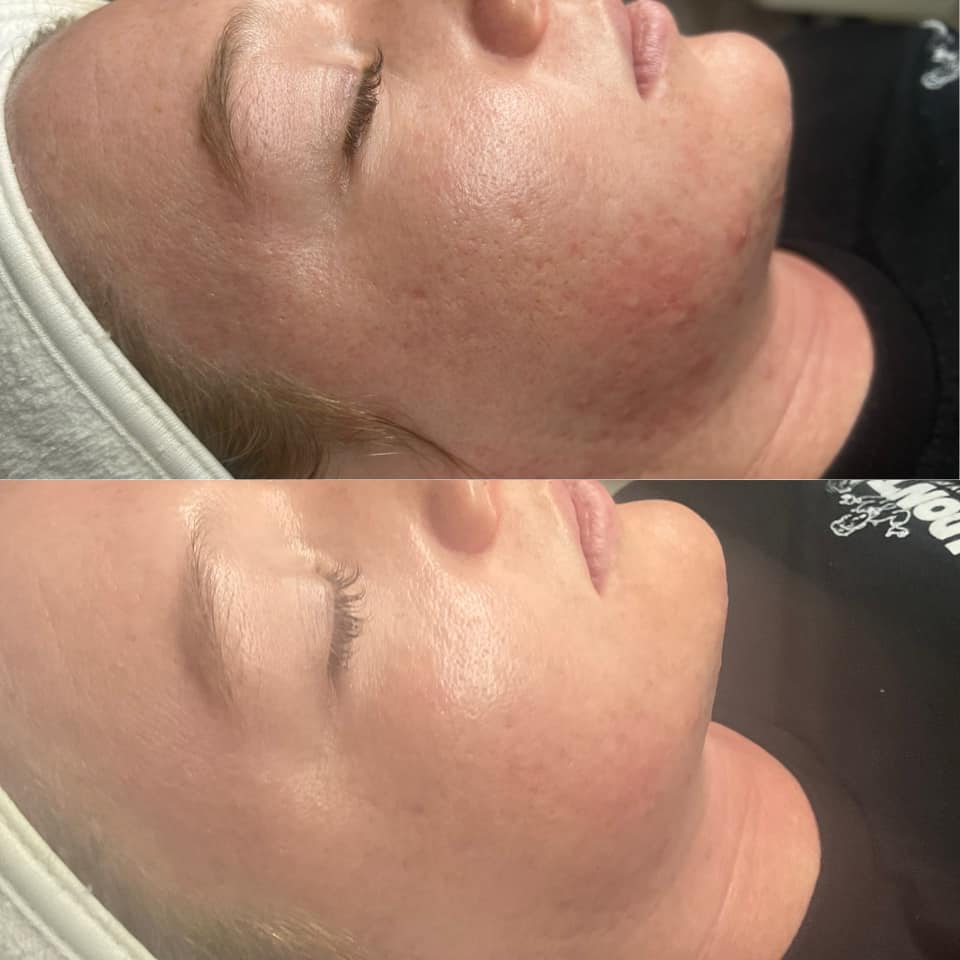 session blue Before & After