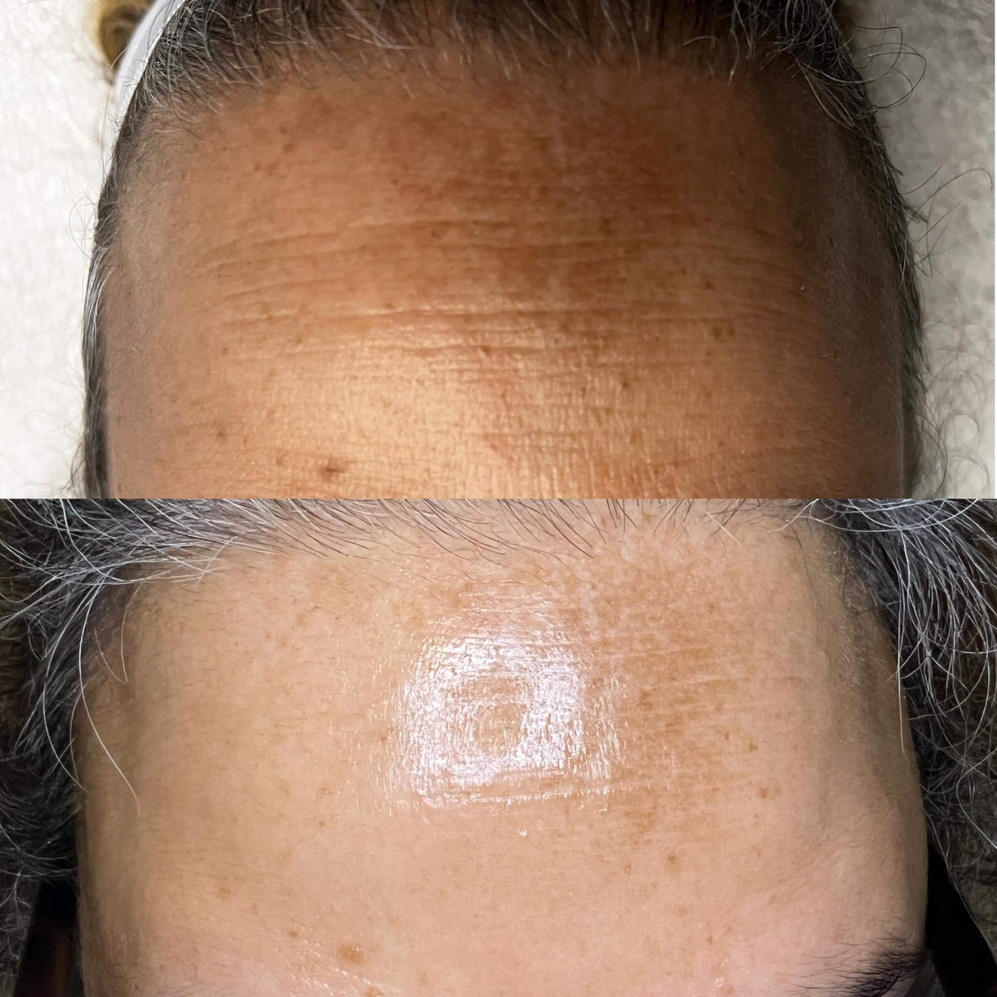 Redness and wrinkles Before & After