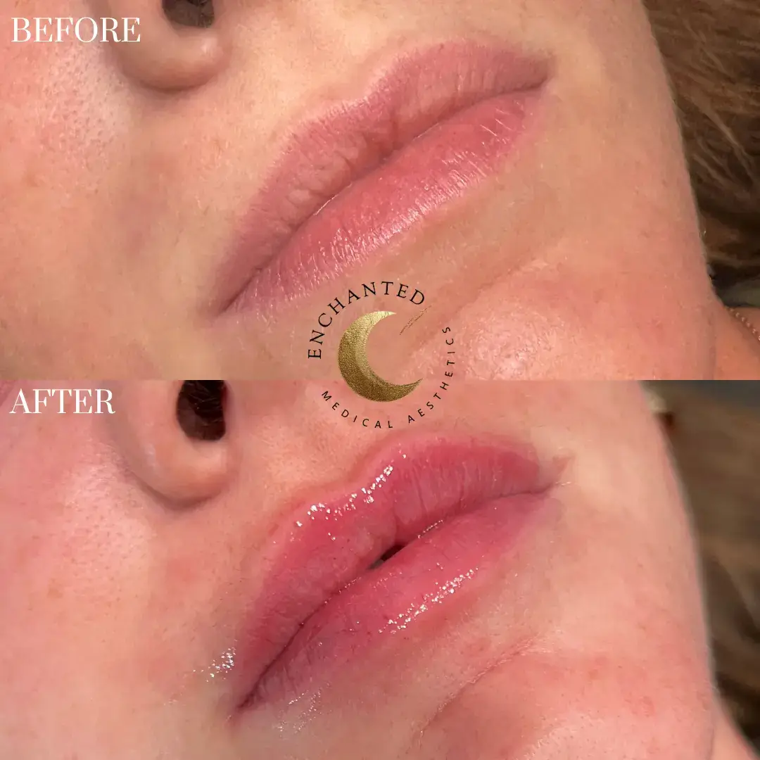 Lip Filler Before and After