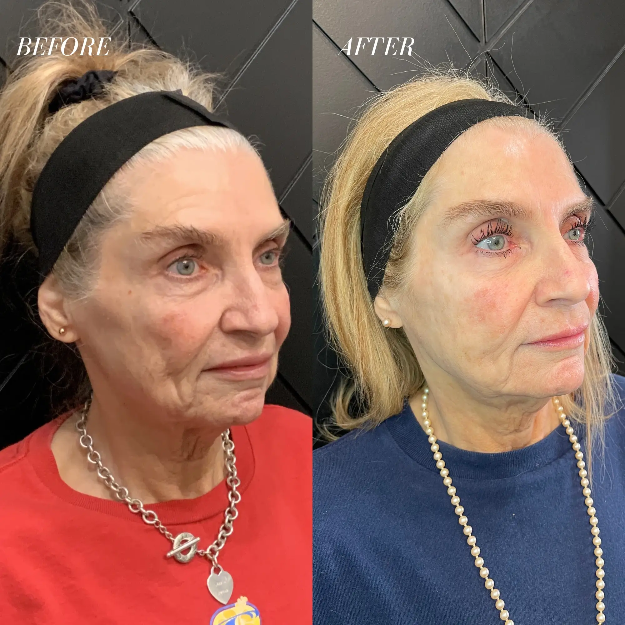 Fillers feb one Before & After: See the Magic of Lip Fillers at Enchanted Aesthetics